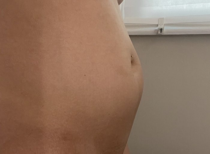 Before: my bloated stomach during SIBO