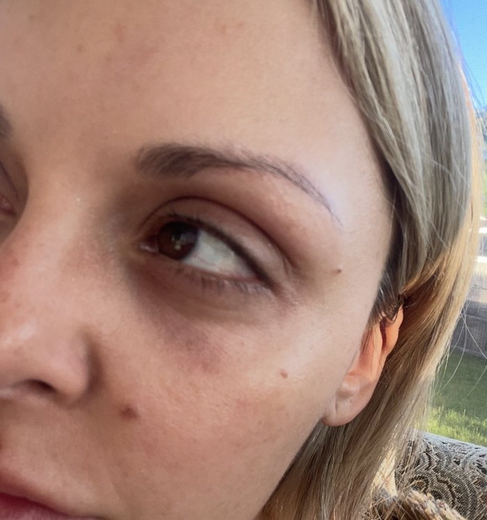 Close-up of one eye with dark circles underneath and redness on the cheek.
