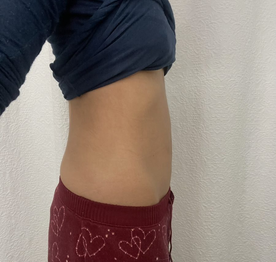 After: my flat stomach after SIBO cleared