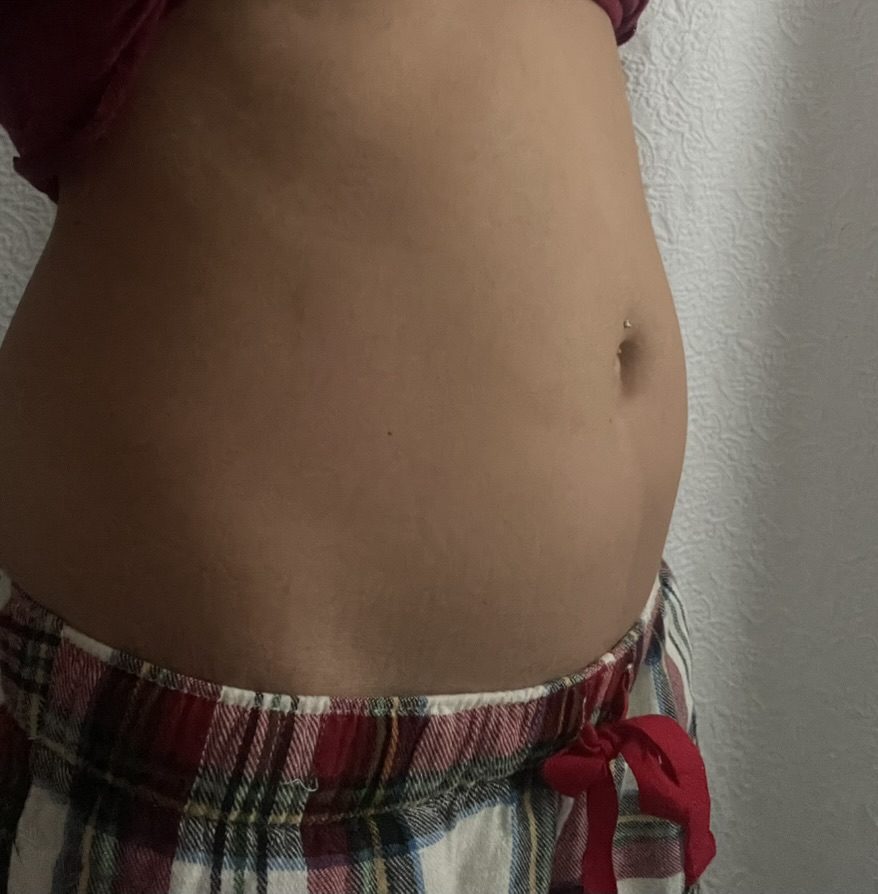 Before: my distended stomach during SIBO